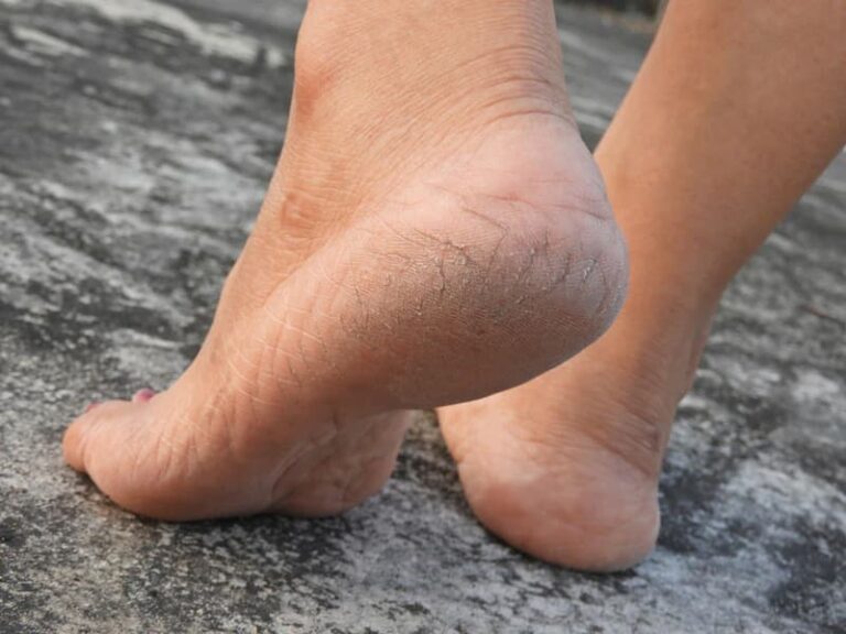 how-to-remove-dead-skin-from-feet-straignt-feet