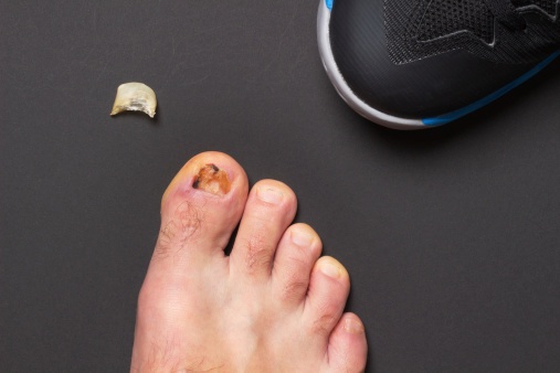 How Long Will It Take For Toenails To Grow Back?