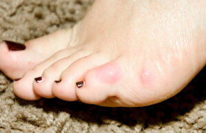 Why Does My Pinky Toe Hurt? Causes And Treatment - Straignt Feet