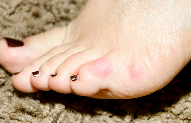 Why Does My Pinky Toe Hurt Causes And Treatment Straignt Feet